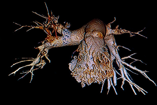 Angiotomography: Right pulmonary thromboembolic process. Medical themes