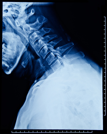 Human neck X-ray Film