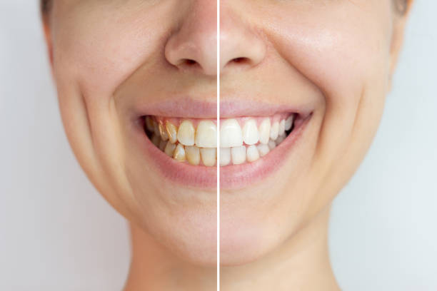 istock Young smiling woman before and after teeth whitening. Difference, comparison 2055140946