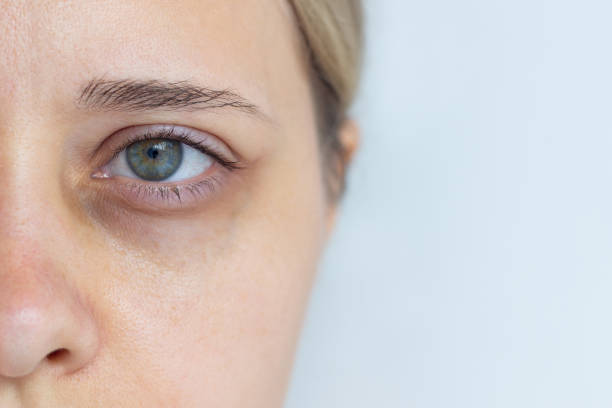 istock Young caucasian woman's face with dark circle under eye isolated on a grey background 2055140984