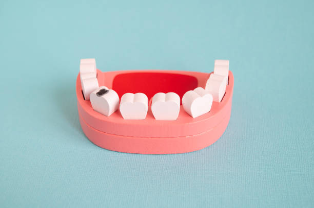 Tooth decay (cavities or caries). Model of a jaw with teeth on a turquoise background. Wooden toy teeth and mouth.