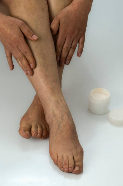 Venous Disorders
Chronic Human foot, varicose vein