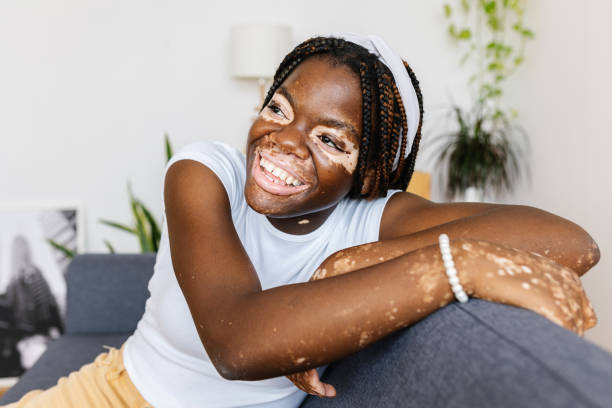 Happy young african woman with vitiligo looking away relaxing on sofa at home