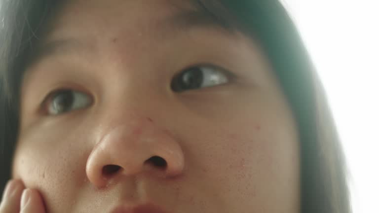 Girl with acne on her face.