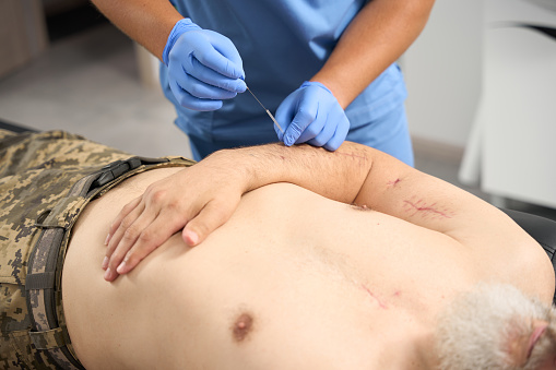 Specialist conducts an acupuncture session on a patient with scars on his body, a man in military clothing
