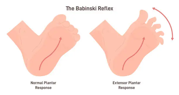 Vector illustration of Babinski reflex. Stimulation of the lateral plantar aspect of the foot leads