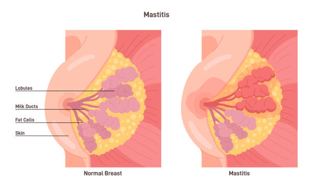 mastitis. gruczoł sutkowy z zapaleniem zrazika piersi - lactiferous duct stock illustrations