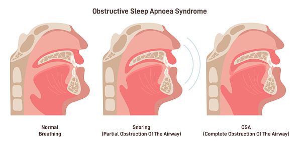Snoring and OSA. Sleep apnea, snoring syndrome anatony. Partial or complete obstruction of airway. Flat vector illustration