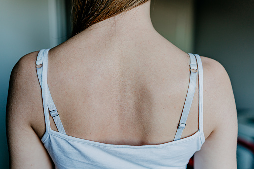 Woman with sunburn on back and shoulders