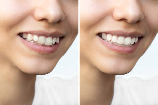 istock Young woman's smile before and after teeth straightening 2065536057