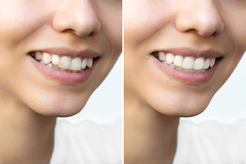 Young woman's smile before and after teeth straightening. Ideal, beautiful shape of teeth after installation of veneers or braces. Whitening. Patient at dental orthodontic clinic.