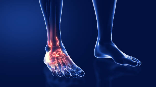 istock sprains and dislocations to the ankle 2065566306