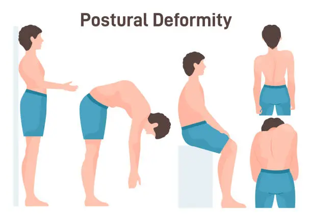 Vector illustration of Postural deformity. Scoliosis, curvature illness of spine. Body posture defect