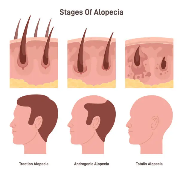 Vector illustration of Hair loss stages. Male alopecia or balding process. Man head side view