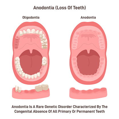 Anodontia. Rare genetic disorder characterized by the congenital absence of all primary or permanent teeth. Dental problem of missing tooth. Flat vector illustration