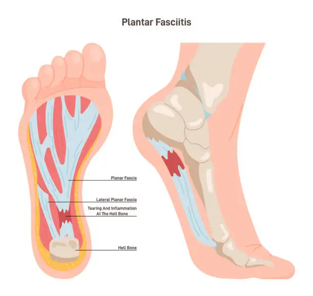 Vector illustration of Plantar fasciitis. Plantar fascia inflammation or tearing. Disorder
