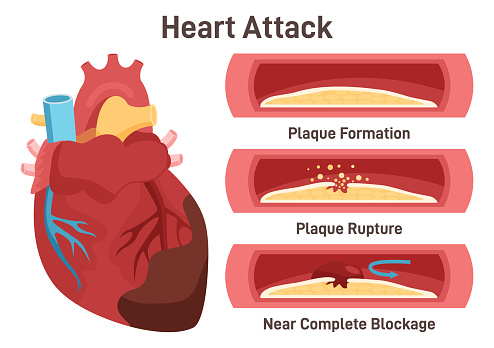 Heart attack mechanism. Damaged heart, blood vessel section with fatty deposit accumulation. Thrombus in the artery preventing heart tissue from getting oxygen and nutrients. Flat vector illustration