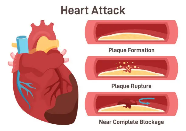 Vector illustration of Heart attack mechanism. Damaged heart, blood vessel section