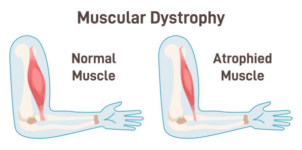 Muscular dystrophy. Healthy muscle versus atrophied one. Anatomical structure Muscular dystrophy. Healthy muscle versus atrophied one. Anatomical structure of the healthy human muscle and muscle with duchenne disorder. Flat vector illustration myosin stock illustrations