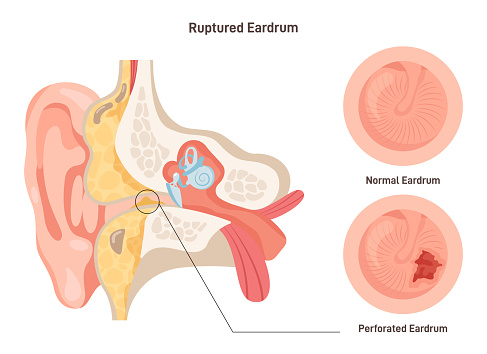 Ruptured eardrum. Anatomy of the human ear. Healthy and perforated tympanic membrane. Flat vector illustration