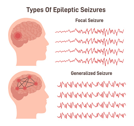 Types of epilepsy. Generalized and focal seizures. Human brain electrical connectivity and activity. EEG infographic. Flat vector illustration