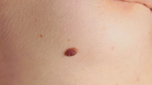 Big birthmark or nevus near the woman's breast. Dermatology, health care. Medical treatment. 4k, slow motion footage.