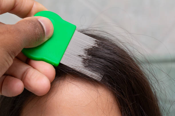 removing lice nits from hair with fine-toothed comb