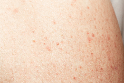 this macro photograph captures a detailed view of a patch of skin with multiple red and inflamed spots, illustrating the typical appearance of skin irritation or an allergic reaction