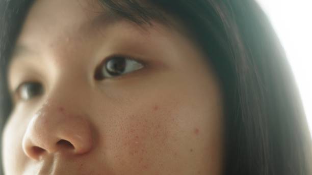 istock Girl with acne on her face. 2067782049