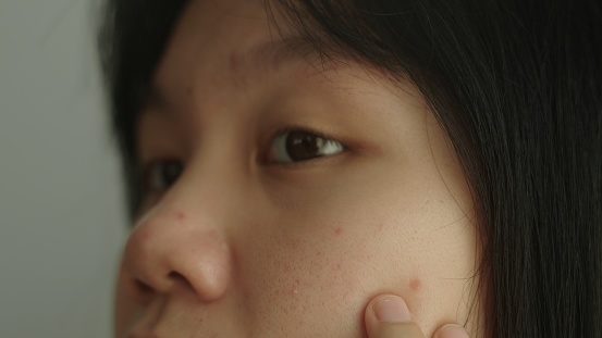Asian girl checking acne on face.