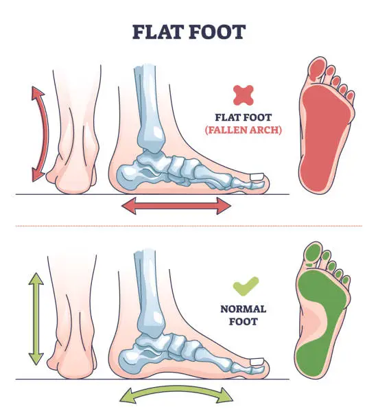 Vector illustration of Flat foot pathology with fallen and normal arch comparison outline diagram