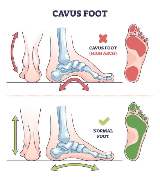 Vector illustration of Cavus foot with abnormal high arch condition to feet bones outline diagram