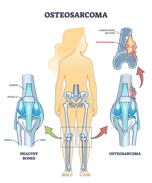 Vector illustration of Osteosarcoma bone tumor as osteogenic sarcoma skeleton cancer outline diagram