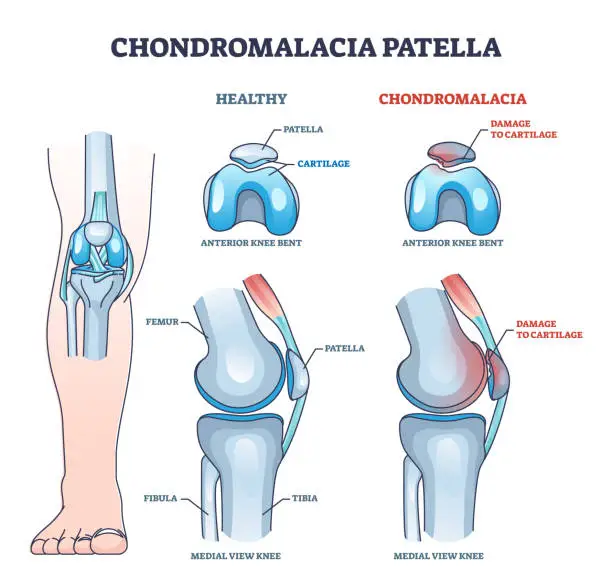 Vector illustration of Chondromalacia patella knee breakdown compared with healthy outline diagram