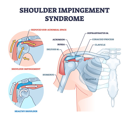 Shoulder impingement syndrome from rubbing rotator cuff outline diagram. Labeled educational scheme with painful and healthy muscular system comparison vector illustration. Upper body skeleton problem