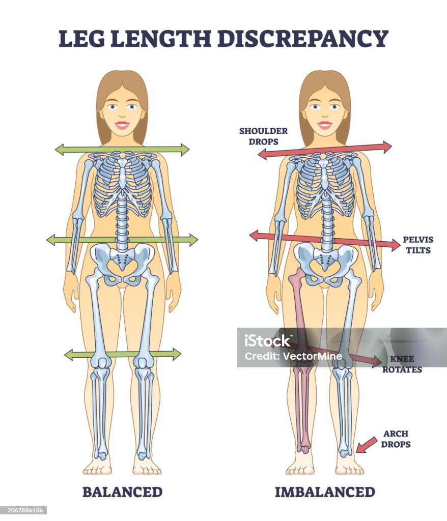 Object Leg Leg Length Discrepancy Condition With Imbalanced Skeleton Outline ...