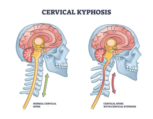 Vector illustration of Cervical kyphosis condition with spine and neck curvature outline diagram