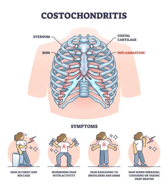 Vector illustration of Costochondritis as chest wall pain or costosternal syndrome outline diagram