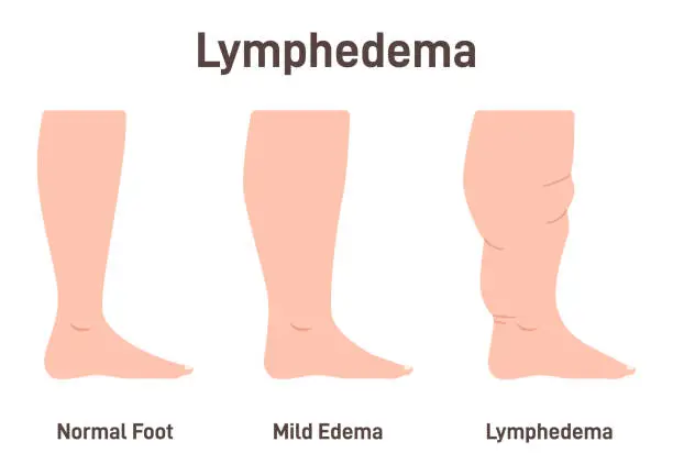 Vector illustration of Lymphedema stages. Lymphatic system dysfunction disease. Swollen legs,