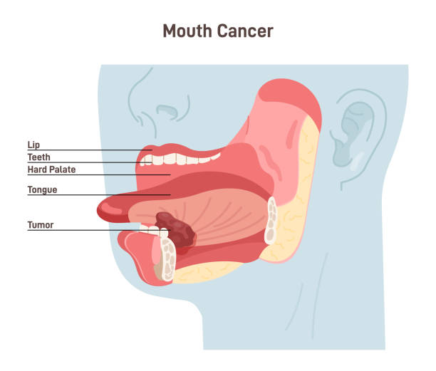 Mouth cancer. Malignant inflammation of oral cavity. Tongue carcinoma. Mouth cancer. Malignant inflammation of oral cavity. Tongue carcinoma. Dangerous effect of cigarette smoking. Flat vector illustration chewing tobacco stock illustrations