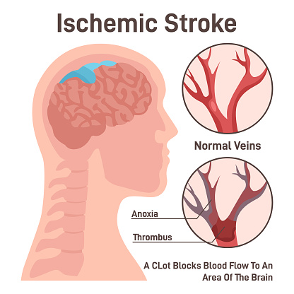 Ischemic brain stroke concept. Thrombus in the cerebral artery preventing brain tissue from getting oxygen and nutrients. Emergency medical care. Flat vector illustration