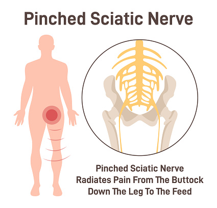 Sciatica. Pinched sciatic nerve causing pain and inflammation in pelvis, leg and hip. Human nervous system and skeleton anatomical poster. Flat vector illustration