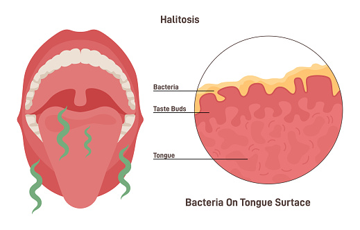 Oral hygiene concept. Halitosis, chronic bad stinky breath, bacterial oral disease. Bacteria spreading all over mouth and tongue. Dental hygiene and teeth care. Flat vector illustration