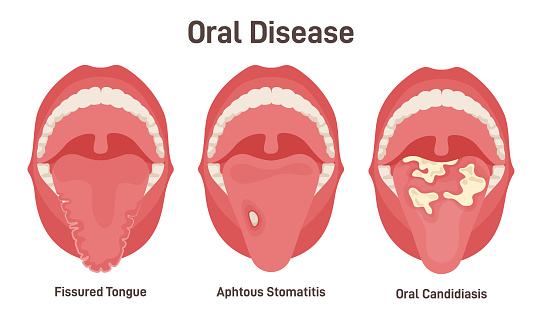 Tongue problems set. Fissured tongue, oral candidiasis and aphthous stomatitis on the tongue. Sore oral cavity, mouth disease symptoms. Flat vector illustration