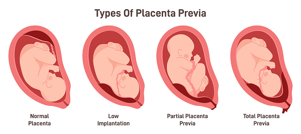 Different placental locations during pregnancy. Placenta previa, total, low and partial. Pregnancy pathology set. Flat vector illustration