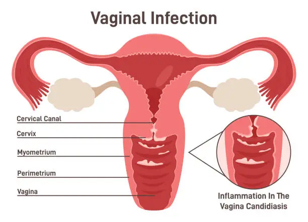 Vector illustration of Female reproductive system. Vaginal yeast infection are due to excessive