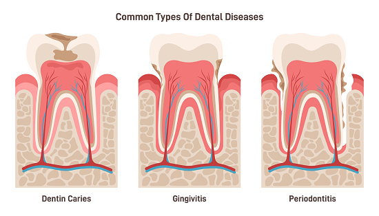Dental disease set. Dentin caries, gingivitis and periodontitis. Oral cavity problem. Dental education poster. Flat vector illustration