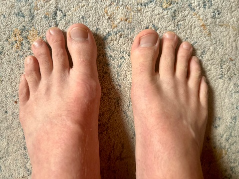 Close-up Of A Woman's Feet With Edible Mushrooms Between The Toes