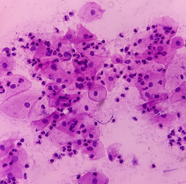 komórki raka szyjki macicy. atypowe komórki płaskonabłonkowe o nieokreślonym znaczeniu (ascus), rak szyjki macicy, wymaz cytologii, cytologia. - cancer cell flash zdjęcia i obrazy z banku zdjęć