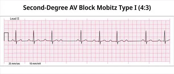 Vector illustration of ECG Second Degree AV Block Mobitz Type 1 (4:3) - 8 Second Paper Electrocardiogram